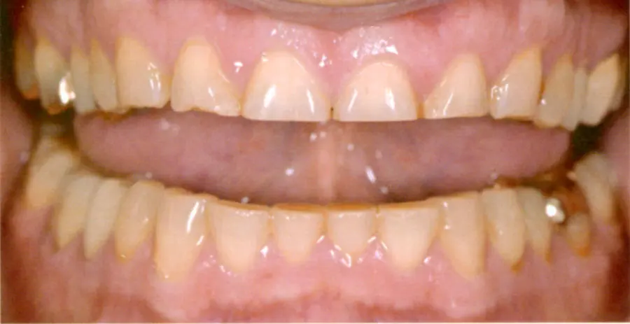 Abrasionsgebiss vor Behandlung