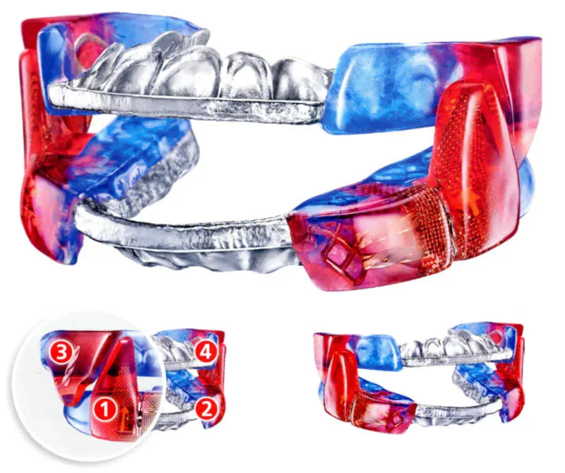 Unterkieferprotrusionsschiene